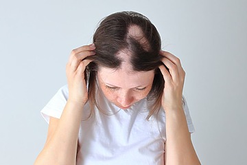 alopecia areata