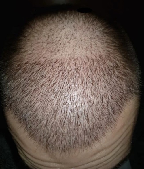 hair growth post hair transplant