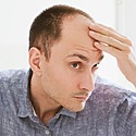Norwood Scale: Causes, Stages & Treatments