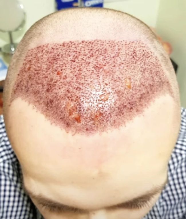 patient post hair transplant