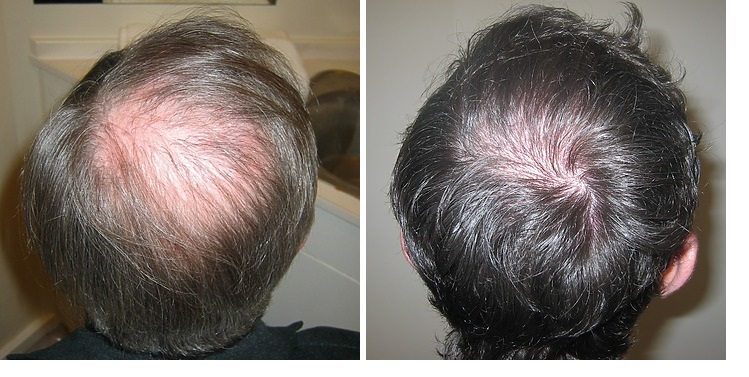 Crown before and 12 months after 2300 grafts FUE hair transplant