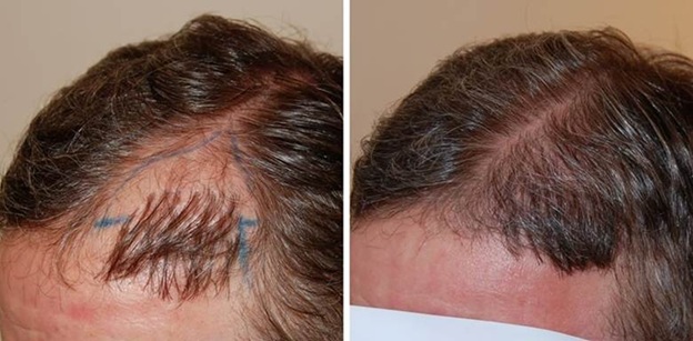 Patient before and after plug repair hair transplant