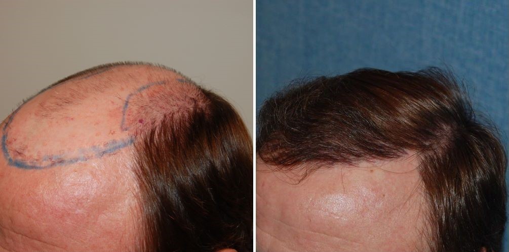 Patient’s temple before and 7 months after 1900 grafts FUT hair transplant