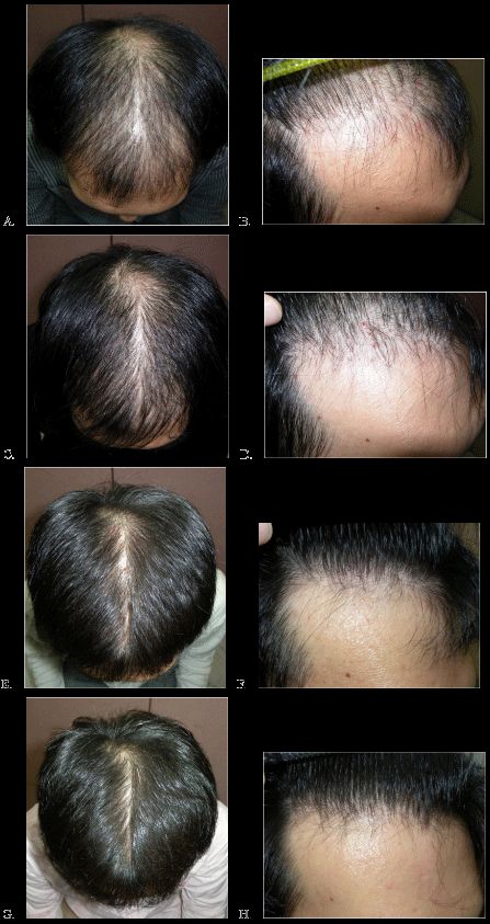 Results of using daily Finasteride to combat hair loss over 60 months