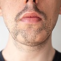 Alopecia Barbae: Causes, Diagnosis & Treatment