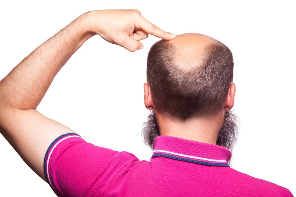 How Many Hair Transplants Can You Have?