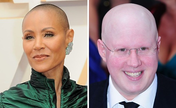 12 Celebrities With Alopecia: Dealing With Hair Loss