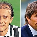 Antonio Conte Hair Transplant: Everything You Need To Know