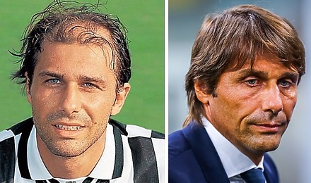 Antonio Conte Hair Transplant