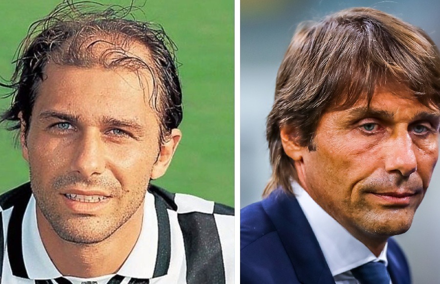 Antonio Conte Hair Transplant