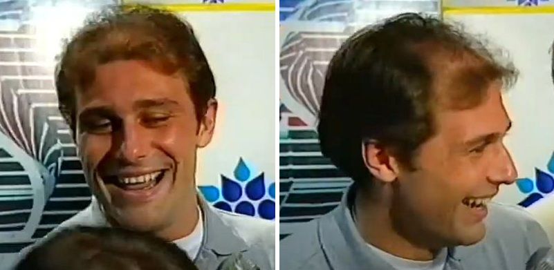 Antonio Conte's hair loss in 1995