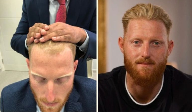 Ben Stokes before and after hair transplant