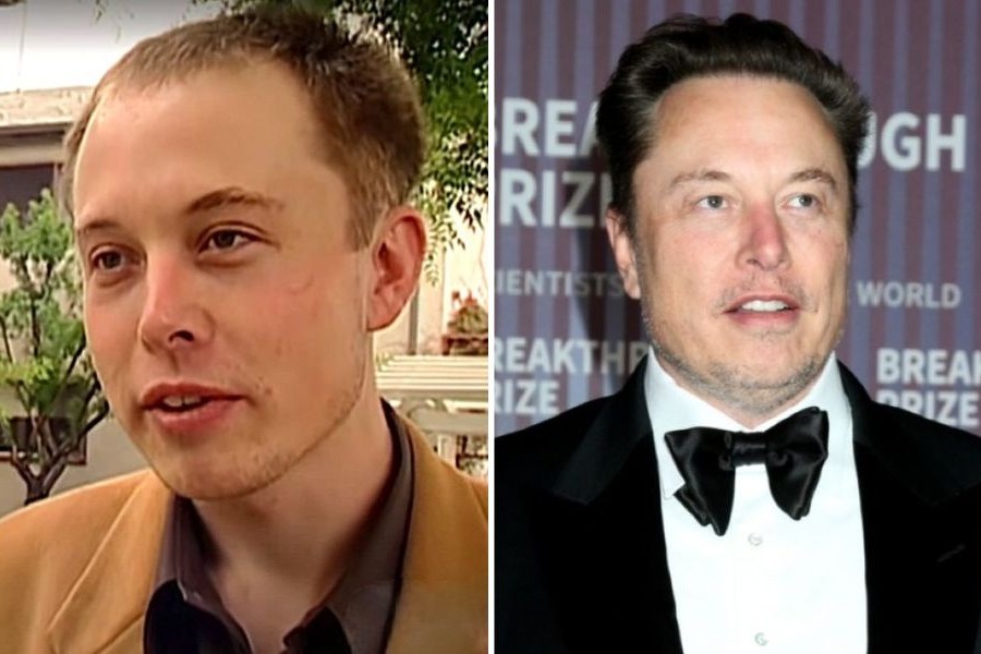 Elon Musk Hair Transplant