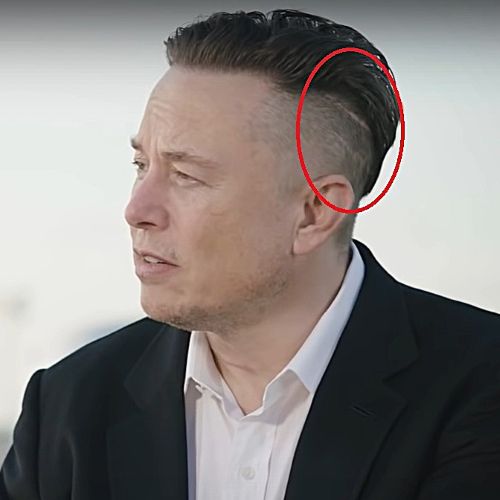 Elon Musk hair transplant scar