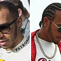 Lewis Hamilton Hair Transplant: Everything You Need To Know