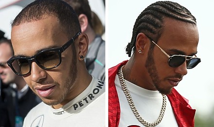 Lewis Hamilton Hair Transplant