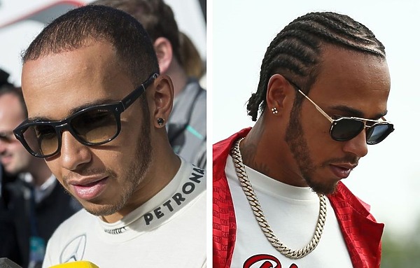 Lewis Hamilton hair transplant