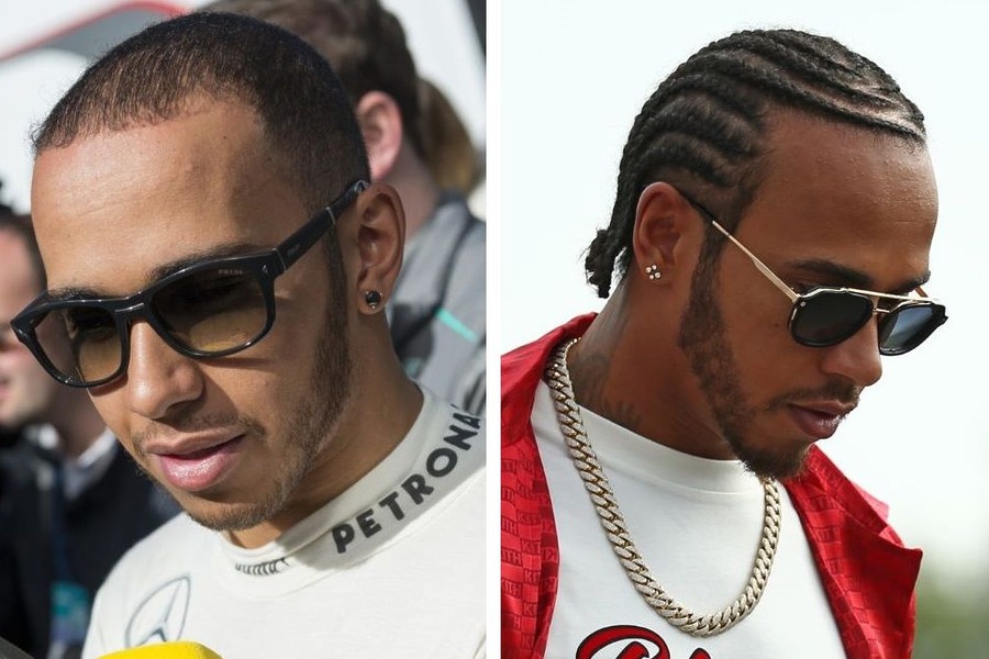 Lewis Hamilton Hair Transplant