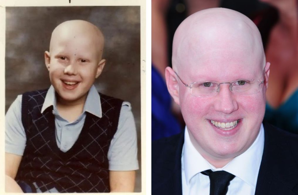 Matt Lucas bald as a child (left) and as an adult (right)