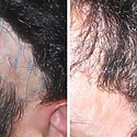 Hair Transplant Into Scar Tissue: Does It Work?