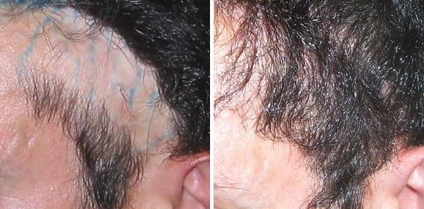 hair transplant on scar