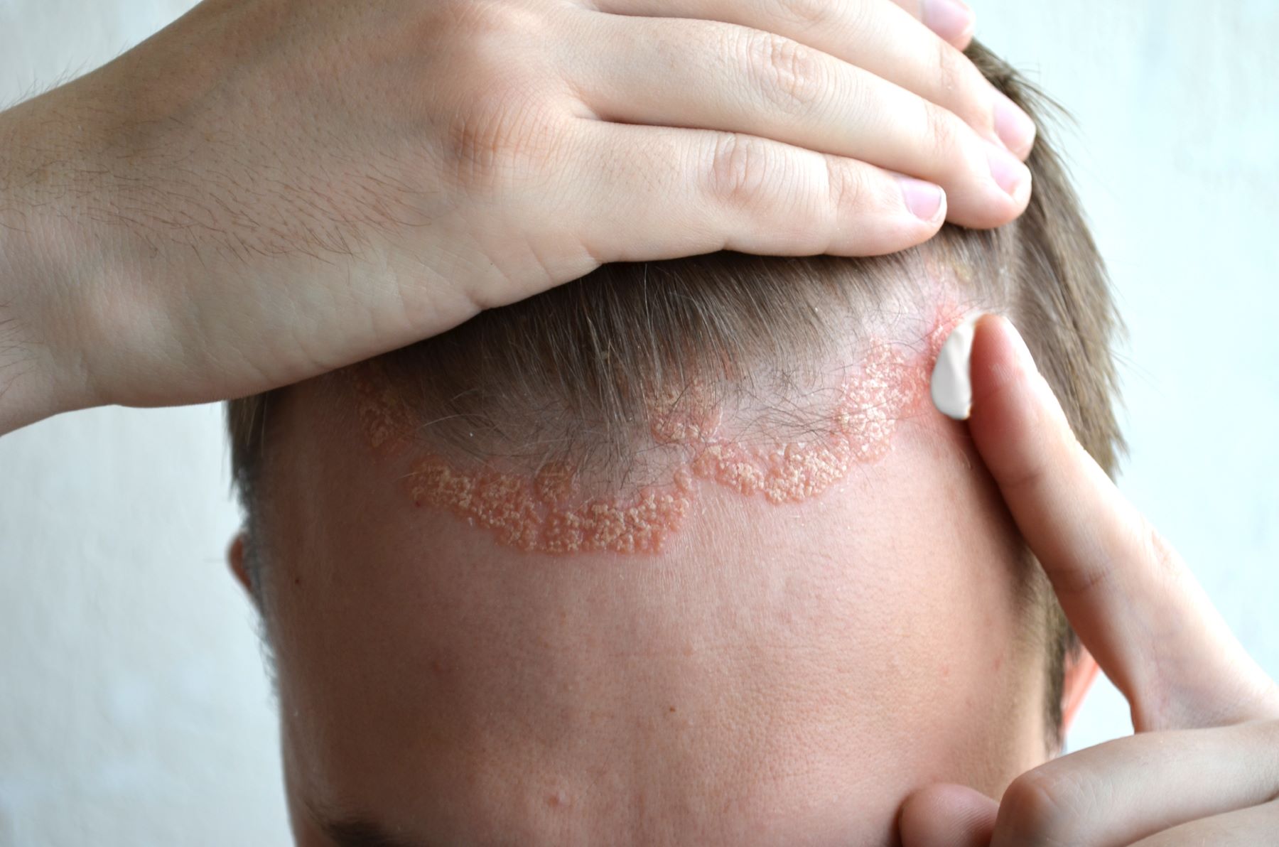 Psoriasis can cause hair loss