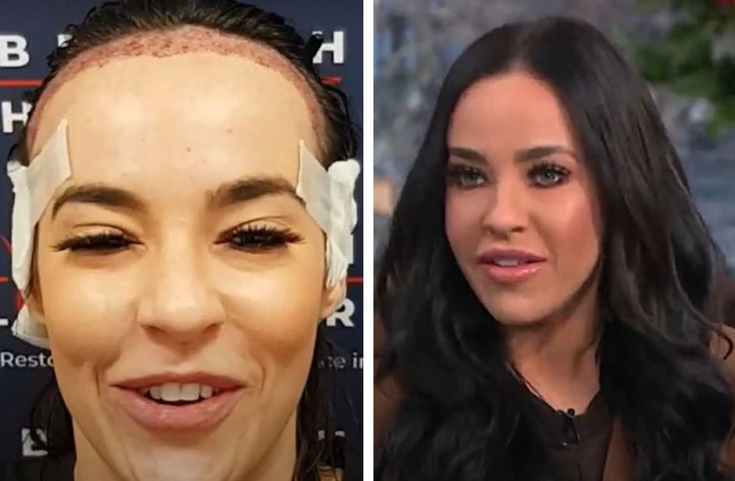 Stephanie Davis right after hair transplant surgery (left) and months after hair transplant (right)
