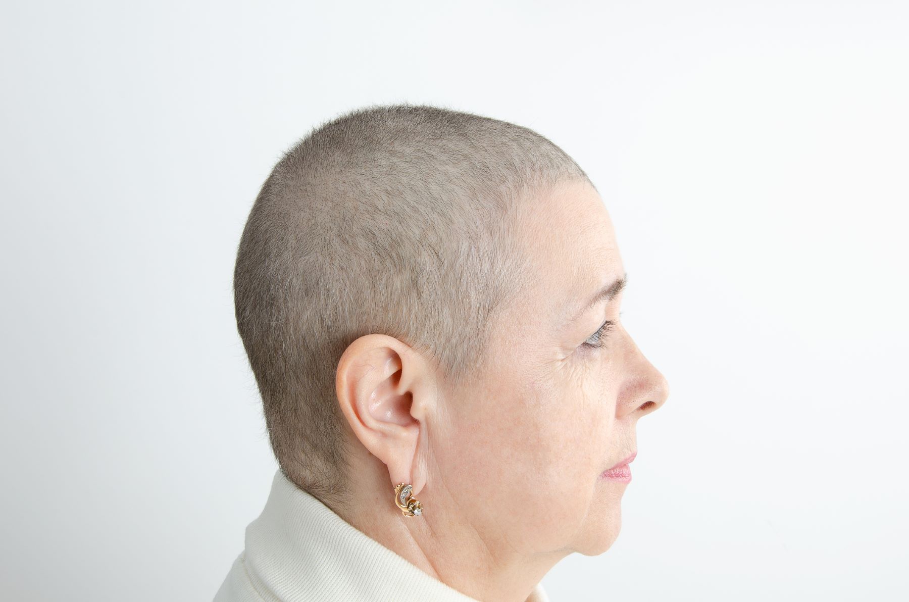 Woman regrowing hair after chemotherapy-induced hair loss