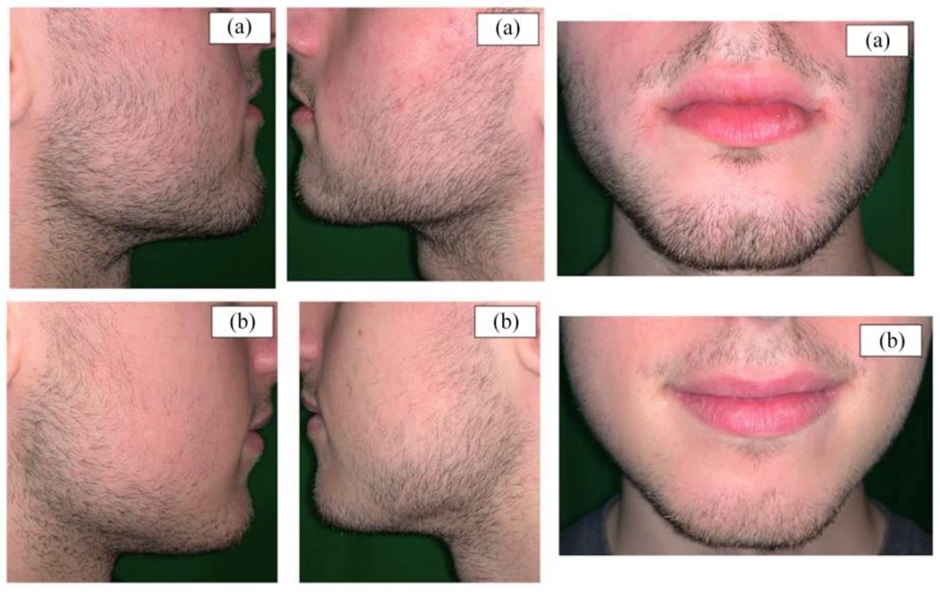 Comparison of twins using Minoxidil for beard growth