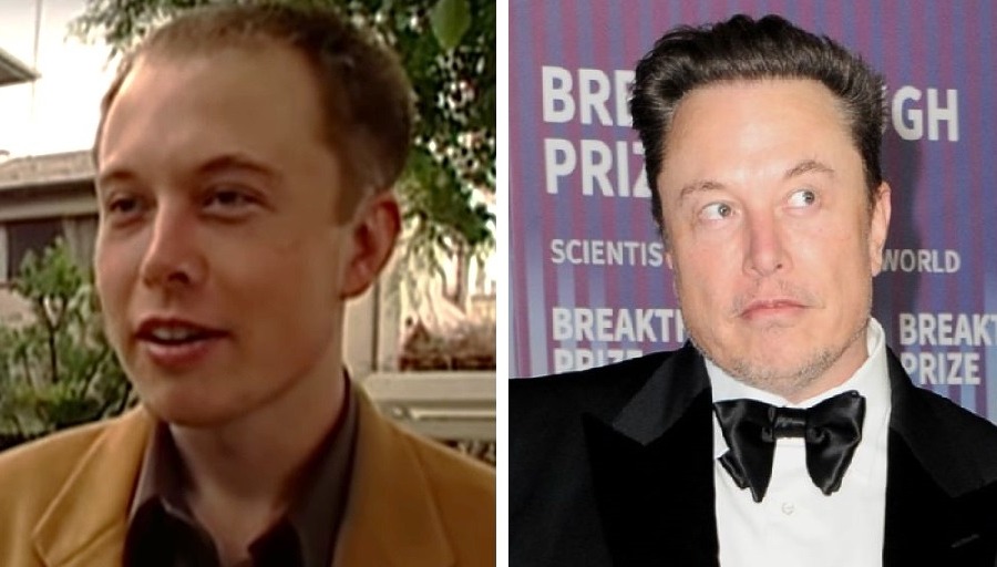 Elon Musk Hair Transplant