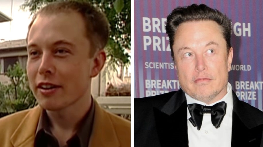 Elon Musk hair transplant