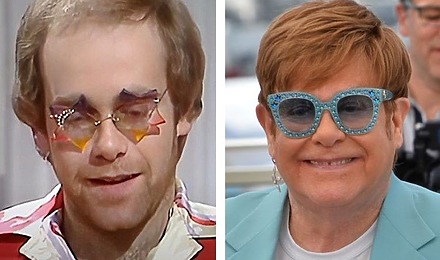 Elton John Hair Transplant