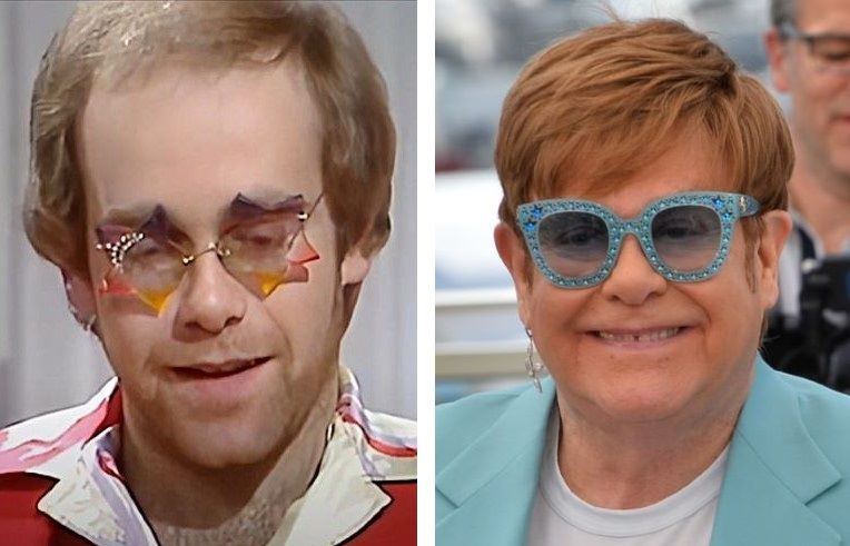 Elton John hair transplant