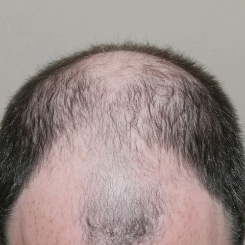 Male pattern baldness