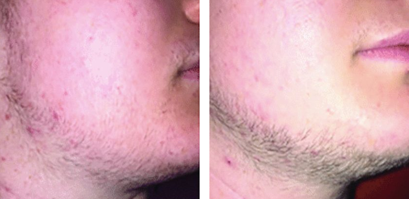Minoxidil before and after photos