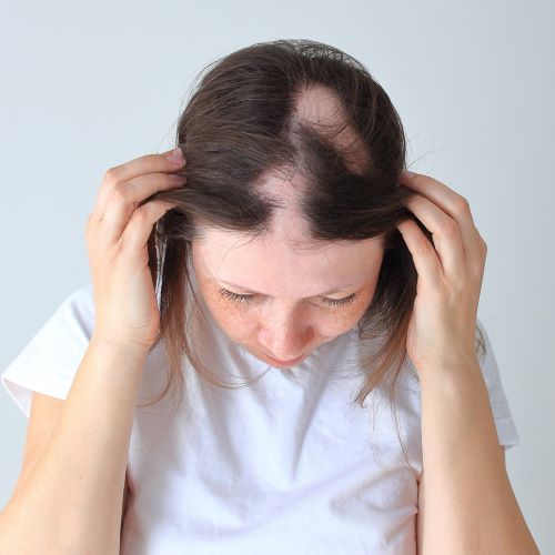 Person with alopecia areata