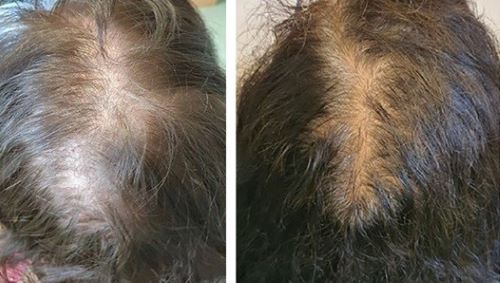 Telogen effluvium hair loss