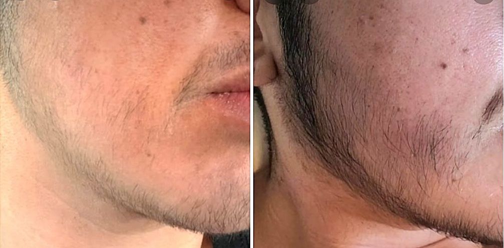 Transgender man before and after using Minoxidil and derma rolling for beard growth