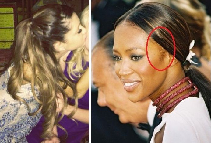celebrity examples of traction alopecia