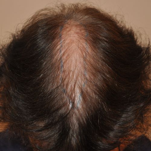 female pattern baldness