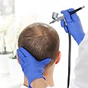 Hair Transplant Alternatives