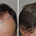 1500 Grafts Hair Transplant: Coverage, Results, Costs