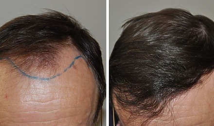 1500 Grafts Hair Transplant