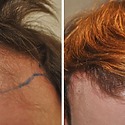 2000 Grafts Hair Transplant: Coverage, Results, Costs