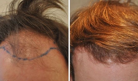 2000 Grafts Hair Transplant