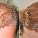 3000 Grafts Hair Transplant: Coverage, Results, Costs