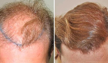 3000 Grafts Hair Transplant