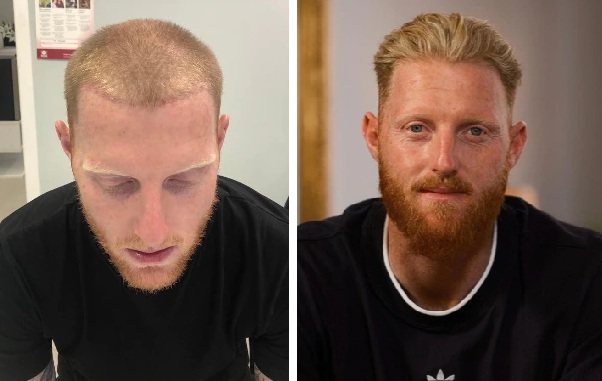 Ben Stokes hair transplant at the Wimpole Clinic