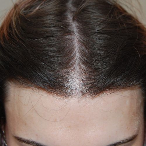FUT Hair Transplant, Wimpole Clinic