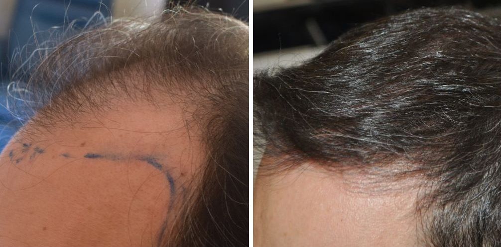 Patient’s temple before and 7 months after 2800 grafts FUT hair transplant